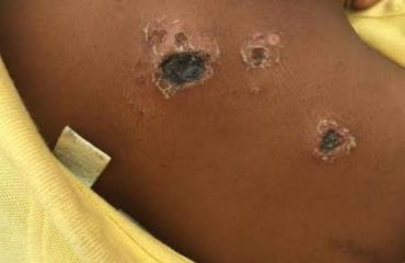 L'épidémie d'anthrax confirmée sur les cadavres de 47 hippopotames dans le territoire de Rutshuru