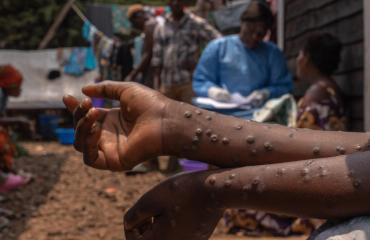 RDC : légère baisse des cas de choléra et suivi du M-pox à la neuvième semaine de 2026