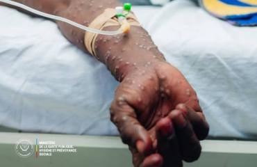 RDC : fin de la riposte contre le M-pox, le choléra reste sous surveillance