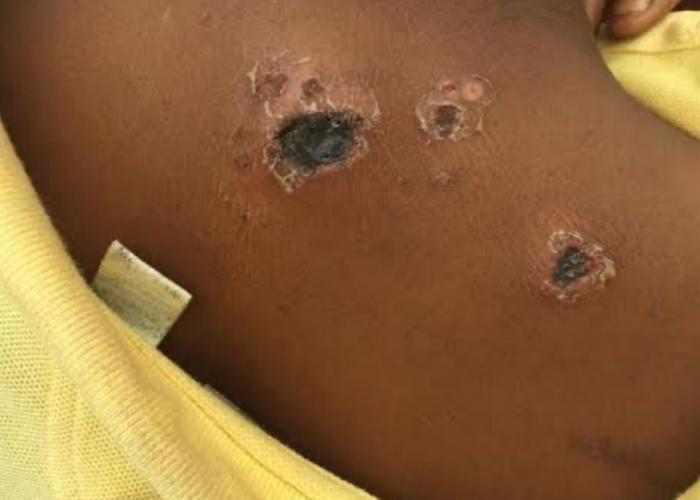 L'épidémie d'anthrax confirmée sur les cadavres de 47 hippopotames dans le territoire de Rutshuru