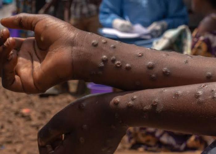 Mpox au Sud-Kivu : l'épidémie s'aggrave, 14 144 cas et 15 décès signalés en 2025
